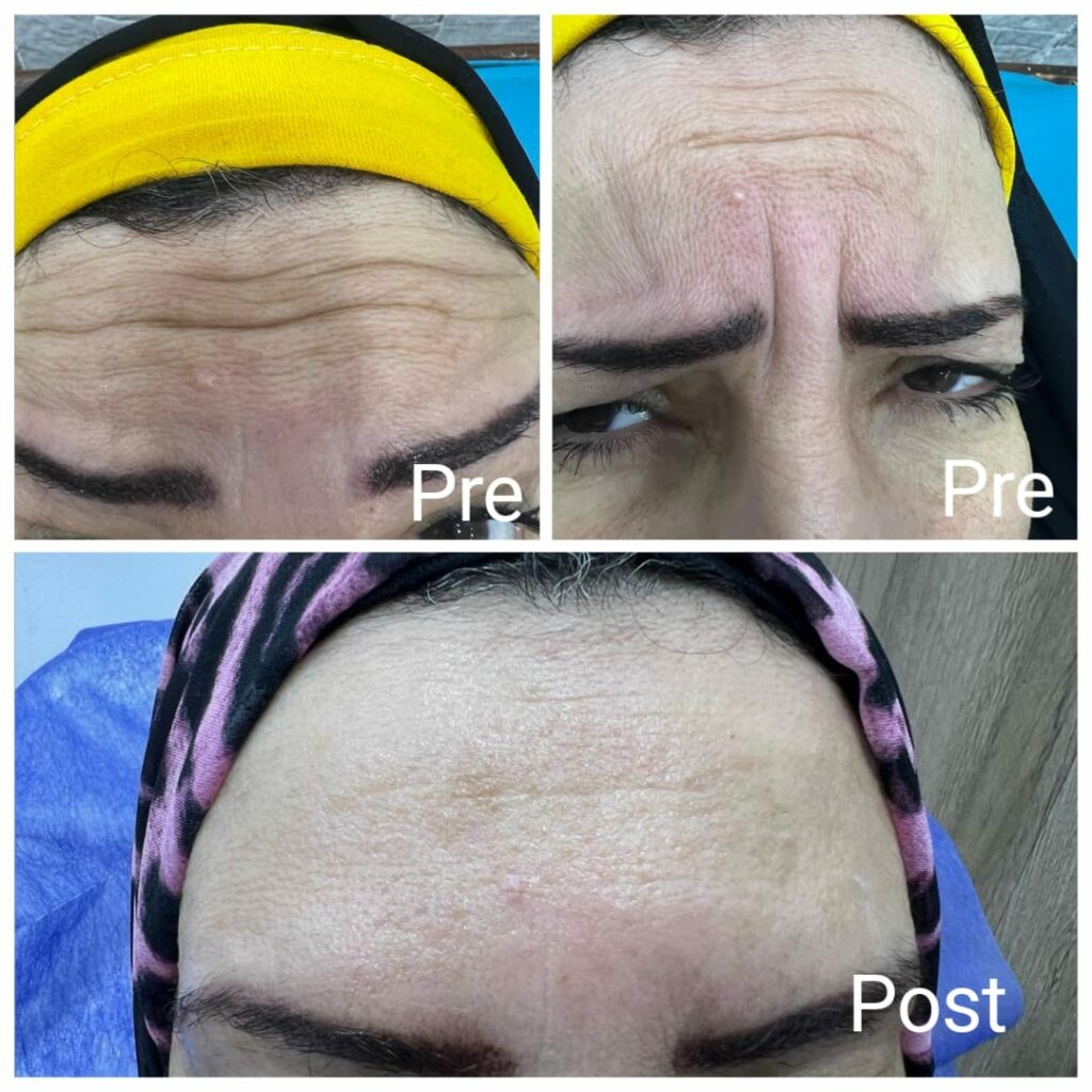 Get rid of gallabela anger mark